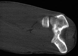 Osteoid Osteoma - CTisus CT Scan