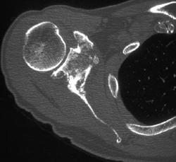 Lymphoma - CTisus CT Scan