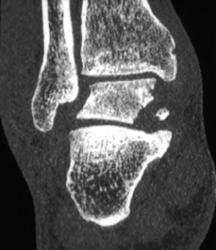 Fracture of the Talus - CTisus CT Scan