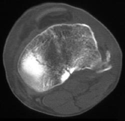 Tibial Plateau Fracture - CTisus CT Scan