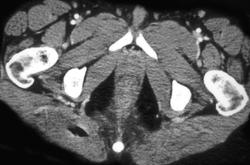 Abscess on Gluteal Muscle - CTisus CT Scan