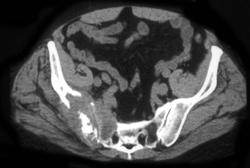 Matastases to Iliac and Sacral Bones - CTisus CT Scan