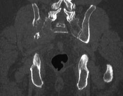 3D of Bone Metastases - CTisus CT Scan