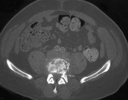 Lymphoma - CTisus CT Scan