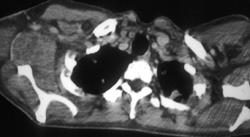 Abscess Right Axilla - CTisus CT Scan