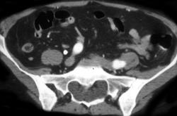 Marfan Sacrum With Dural Ectasia - CTisus CT Scan