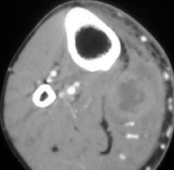 Calf Abscess - CTisus CT Scan