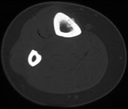 Stress Fracture - CTisus CT Scan