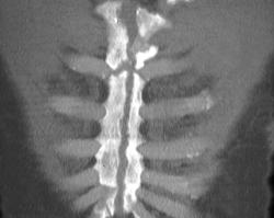 Nonunion Sternum - CTisus CT Scan