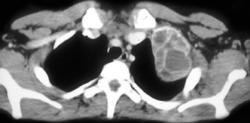 Probable Aneurysmal Bone Cyst (ABC) in 12 Year Old Female - CTisus CT Scan