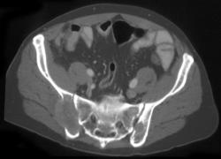 Renal Cell Carcinoma With Metastases to Bone - CTisus CT Scan