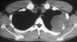 Ewing Sarcoma - CTisus CT Scan