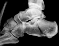 Calcaneal Fracture - CTisus CT Scan