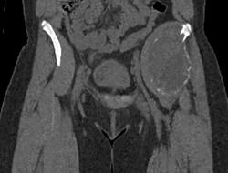 Lytic Lesion C/w Giant Cell Tumor - CTisus CT Scan