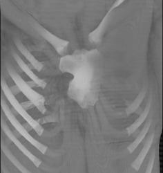 Fused Sternum - CTisus CT Scan