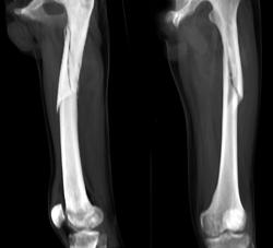 Femur Fracture - CTisus CT Scan