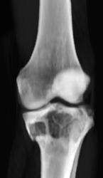 Fracture Through Bone Cysts - CTisus CT Scan