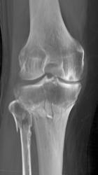 Tibial Plateau Fracture - CTisus CT Scan