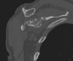 Lymphoma - CTisus CT Scan