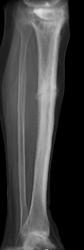 Stress Fracture - CTisus CT Scan