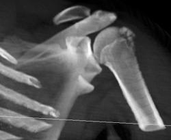 Humeral Fracture - CTisus CT Scan