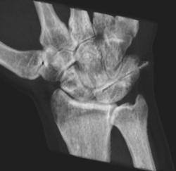 Pin for Fracture Repair - CTisus CT Scan