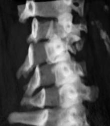 C3 Fracture - Dislocation - CTisus CT Scan