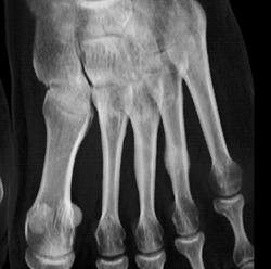 Stress Fracture 4th Metatarsal - CTisus CT Scan