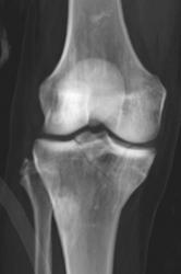 Tibial Plateau Fracture - CTisus CT Scan