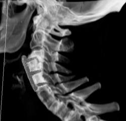 Fusion of C-spine - CTisus CT Scan