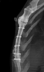 Exuberant Callus at Site of Sternotomy - CTisus CT Scan