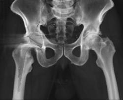 Total Hip Replacement (THR) in 3D - CTisus CT Scan