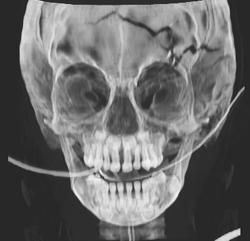 Skull Fracture - CTisus CT Scan