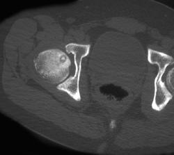 Osteoid Osteoma - CTisus CT Scan