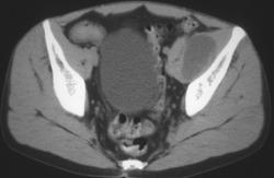 Psoas Abscess (hx Crohn Disease) - CTisus CT Scan