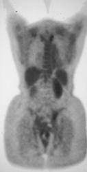 Stress Fracture Sacrum - CTisus CT Scan