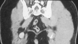 Angiolipoma of the Right Sciatic Nerve - CTisus CT Scan