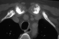 Ankylosing Spondylitis - CTisus CT Scan