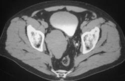 Plexiform Neurofibroma - CTisus CT Scan