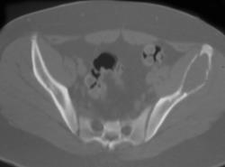 Fracture Through Aneurysmal Bone Cyst (ABC) - CTisus CT Scan