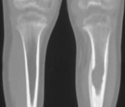 Eosinophilic Granuloma - CTisus CT Scan