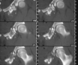 Chondrosarcoma - CTisus CT Scan