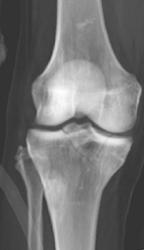 Tibial Plateau Fracture - CTisus CT Scan