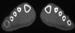 Giant Cell Tumor of the 5th Digit - CTisus CT Scan