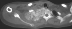 Osteosarcoma of the 1st Rib - CTisus CT Scan