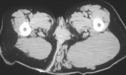 Neurofibromatosis - CTisus CT Scan