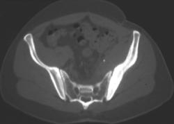 Ewing Sarcoma - CTisus CT Scan