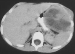 Extraosseous Ewing Sarcoma - CTisus CT Scan