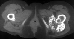 Chondrosarcoma - CTisus CT Scan