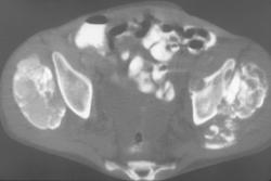 Secondary Hyperthyroidism Due to Renal Failure - CTisus CT Scan